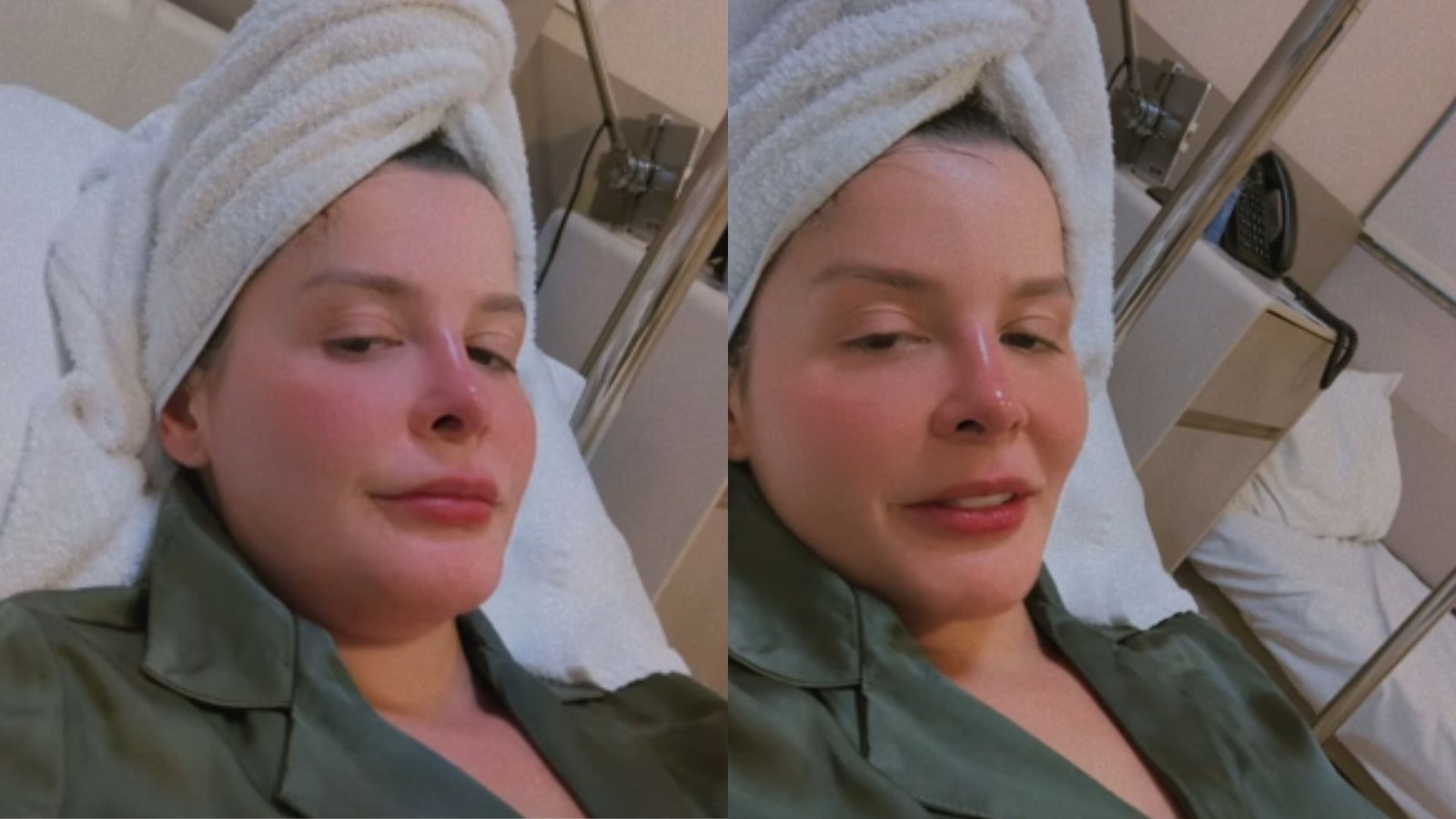 Especialista detalha alopecia androgenética enfrentada por Maraisa e orienta tratamentos - Imagem do artigo