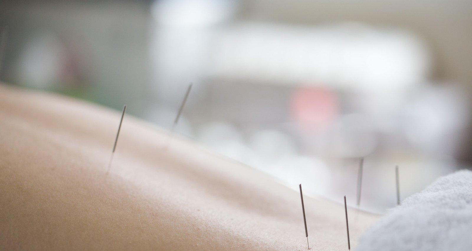 Acupuntura é apontada como aliada contra o estresse típico do fim de ano - Imagem do artigo